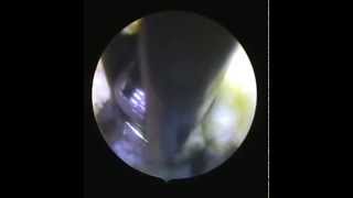 foraminal disc herniation  endoscopic surgery [upl. by Areht]