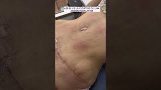 Cicatriz de una abdominoplastia  Dra lina Franco cirugiasplasticas [upl. by Jefferey]