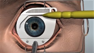 LASIK eye surgery  3D animation [upl. by Atwood326]