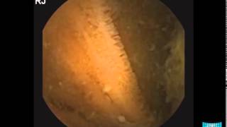 Small Bowel Tumor Detection in Capsule Endoscopy [upl. by Esalb]