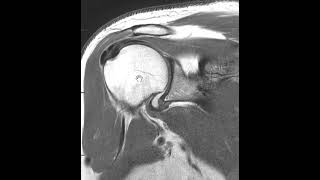 Calcific tendinitis shoulder [upl. by Redd]