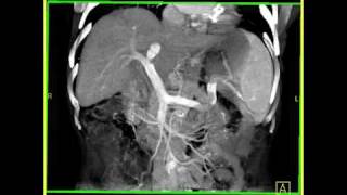 Abdomen Liver Cirrhosis 3D Volume rendering of a cirrhotic liver with collaterals [upl. by Ozzy]