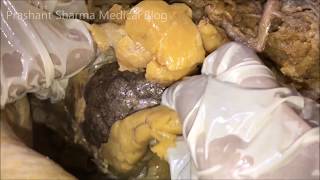 Kidney Dissection  Lobulated Demonstrated Paranephric Fat [upl. by Ahseyk717]