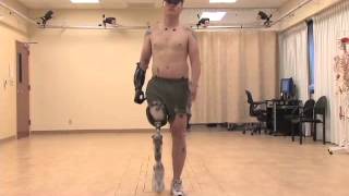 Gait Analysis of a Man in Military Who Was Injured by an IED in Afghanistan [upl. by Matejka]