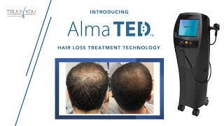 quotAlma TEDquot  Hair Loss Treatment Technology [upl. by Crifasi]