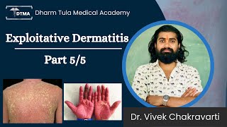 Dermatitis  Exfoliative Dermatitis Hindi  Types  Part 55 Eczema  Skin Disease  Skin Infection [upl. by Nevur]