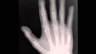 Hyperparathyroidism on Hands on X ray [upl. by Etteuqal]