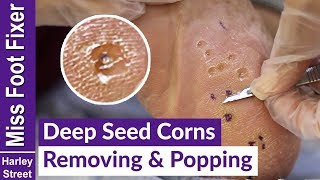 DEEP SEED CORNS REMOVING AND POPPING BY MISS FOOT FIXER MARION YAU [upl. by Germain]