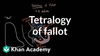 Tetralogy of fallot  Circulatory System and Disease  NCLEXRN  Khan Academy [upl. by Eitac370]