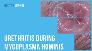 👉 Urethritis during mycoplasma hominis [upl. by Gleeson367]