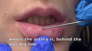 Lip filler injection [upl. by Xonk]