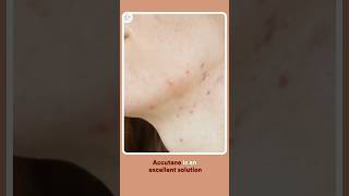 Accutane amp Skincare Essential Tips for Treating Acne [upl. by Jorgensen]