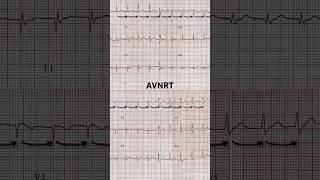 AVNRT ECG Regular and rapid rate [upl. by Ranger]