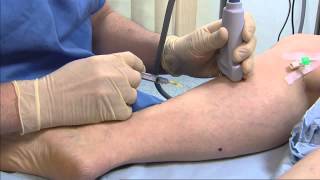 Foam sclerotherapy for varicose veins  Philip Coleridge Smith [upl. by Connett249]