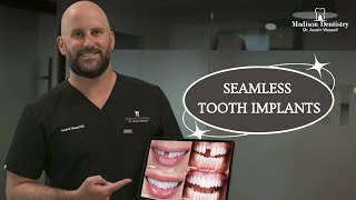 Seamless Tooth Implants [upl. by Wandis]