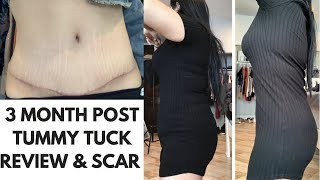 TUMMY TUCK SCAR AND BEFORE AND AFTER PICTURES  PLASTIC SURGERY UPDATE [upl. by Ariajaj]