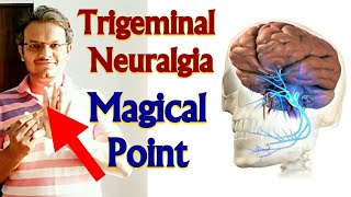 Acupressure Points For TRIGEMINAL NEURALGIA Acupressure For Trigeminal Neuralgia MADE EASY  HINDI [upl. by Emoryt44]