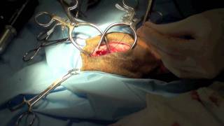 Excision arthroplasty [upl. by Muraida463]