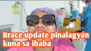 Update brace nka brace na lahat ng ngipin ko [upl. by Treulich]