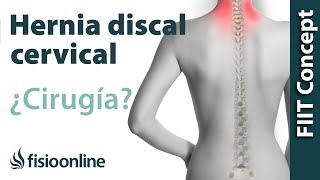 Hernia Discal Cervical cuándo optar por la cirugía u operación quirúrgica [upl. by Eelyr]