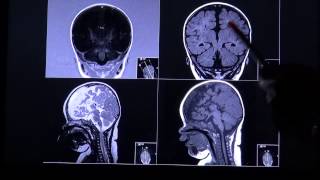 Balkenagenesie  Corpus callosum by RadiologieTV [upl. by Grantham]