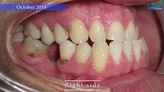 😲 JAW SURGERY and WISDOM teeth management 🦷💕 [upl. by Gardel]