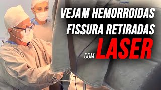 Vejam a fissuraHemorroida retiradas pcirurgia cLASER c anestesia local mostradas neste vídeo [upl. by Elleved]