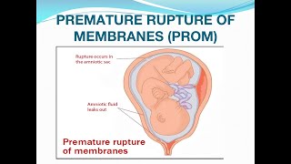 13 PROM AF disorders Pre amp post term labor 212022 [upl. by Bernarr]