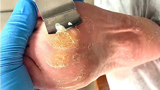 Callus removal from feetampFoot scraping dead skin【Xiao Yan pedicure】stress 17 [upl. by Ladnyc]