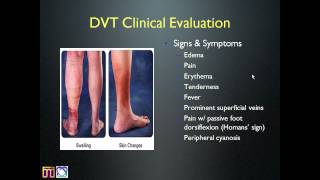 Internal Medicine Grand Rounds  Deep Vein Thrombosismp4 [upl. by Asoj]