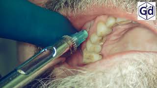 Infiltration Anesthesia for treatment tooth 24 [upl. by Won]