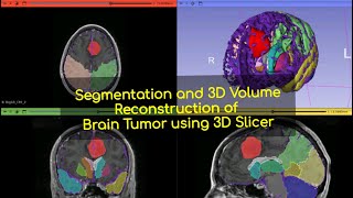 Segmentation and 3d Volume Reconstruction of Brain Tumor using 3d Slicer [upl. by Pinter271]