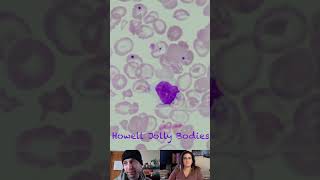 Howell Jolly Bodies vs Pappenheimer Bodies vs Basophilic Stippling [upl. by Ellertnom887]