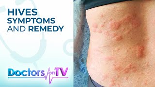 Hives Symptoms and Remedy  DOTV [upl. by Tansey]