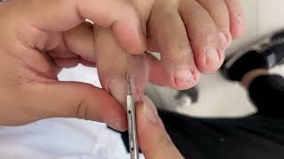 satisfying ingrown toenail removal 012 [upl. by Rachael]