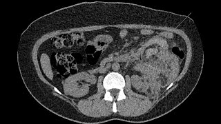 Hemorrhagic renal angiomyolipoma in a tuberous sclerosis phakomatosis patient [upl. by Wallas]