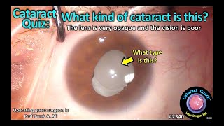 CataractCoach™ 2340 Cataract Quiz What kind of cataract is this [upl. by Ellertal]