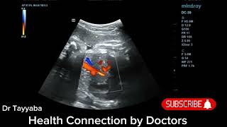 USG Ductus Venosus Doppler At 34 Weeks of Pregnancy  Health Connection by Doctors [upl. by Alessig856]