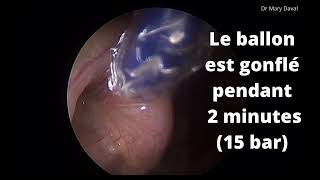 Dilatation de la trompe d’Eustache par ballonnet Stryker [upl. by Rudin]