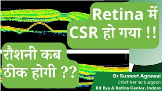 CSR RETINA में SWELLING हो गया  अब नज़र कब ठीक होगी [upl. by Helaine]