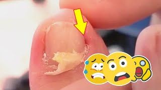 Step by step how to cut ingrown nail by professional [upl. by Saxon]