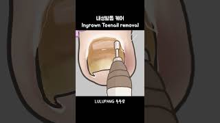 내성발톱 케어 한국인속도 Ingrown Toenail Removal [upl. by Duane137]