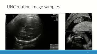 US FAMLI Automated Measurement of fetal biometry [upl. by Ahsirk]