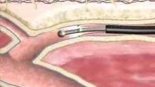 Varicose Veins Closure Procedure at BIDMC [upl. by Hembree]