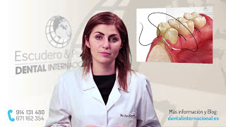 Periodontitis tratamiento · Dental Internacional [upl. by Barram763]