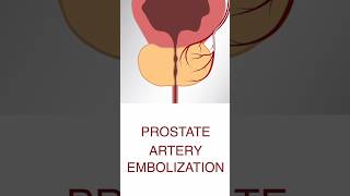 What is Prostate Artery Embolization  Dr Arpit Taunk Apollo Hospital Lucknow [upl. by Assele349]