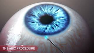 Ophthalmology glaucoma IOP drainage animation [upl. by Zedecrem]