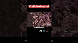 What is Emphysema COPD 🫁 [upl. by Fifine]