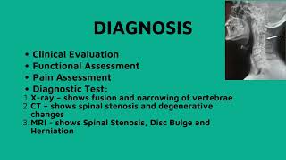 KlippelFeil Syndrome  KlippelFeil Syndrome Physiotherapy Exercises [upl. by Akinom793]