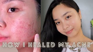 How I healed my acne  Paano nawala ang pimples ko  Arvie Ramos [upl. by Anoved]